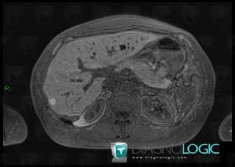 Metastasis, Liver, MRI