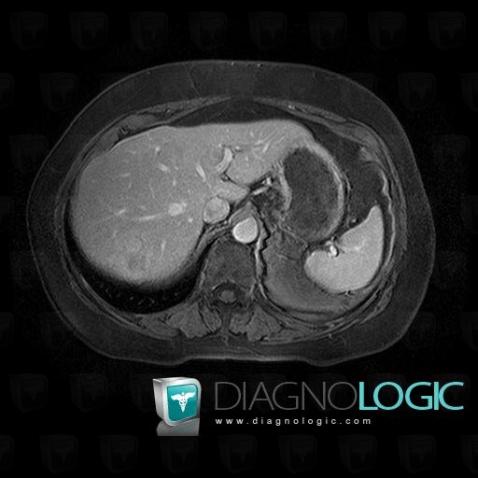 Metastasis, Liver, MRI