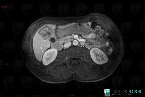 Metastasis, Liver, MRI