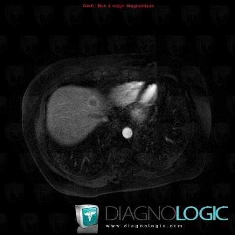 Metastasis, Liver, MRI