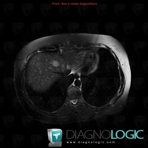 Metastasis, Liver, MRI