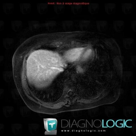 Metastasis, Liver, MRI
