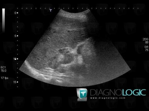 Metastasis, Liver, US