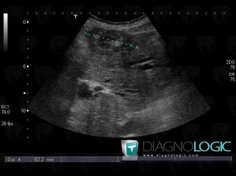 Metastasis, Liver, US