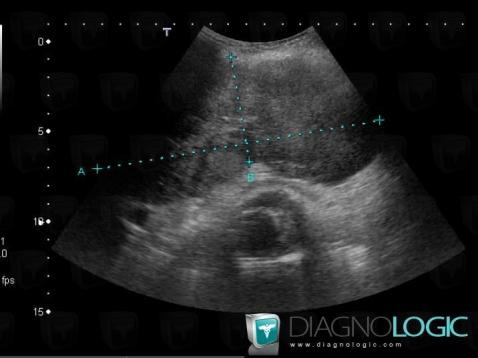 Metastasis, Liver, US