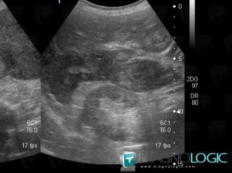 Metastasis, Liver, US