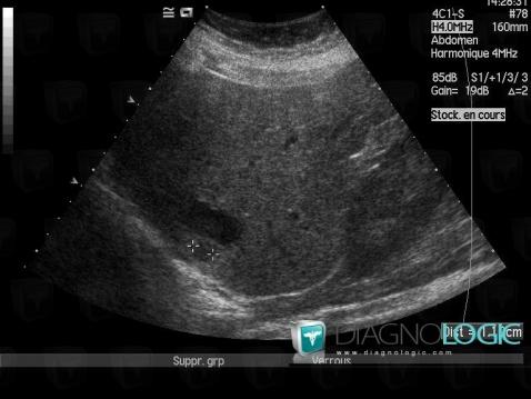 Metastasis, Liver, US