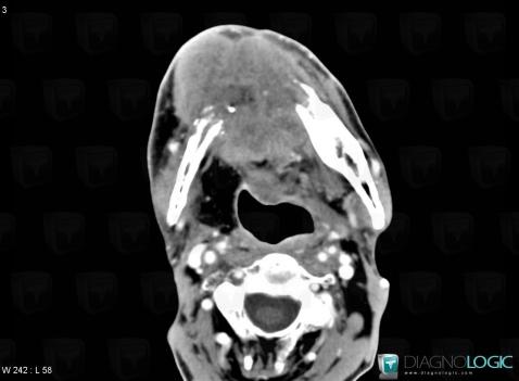 Metastasis, Mandible, CT