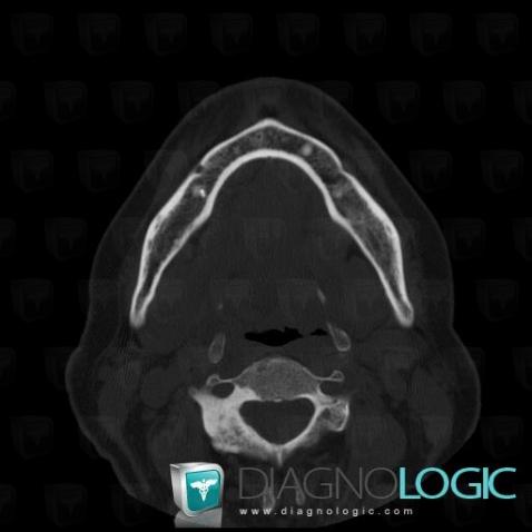 Metastasis, Mandible, CT