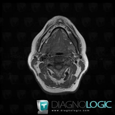 Metastasis, Mandible, MRI