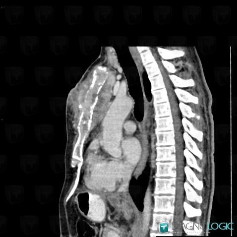 Metastasis, Mediastinum, Chest wall, CT