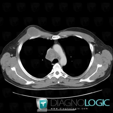 Metastasis, Mediastinum, Chest wall, CT