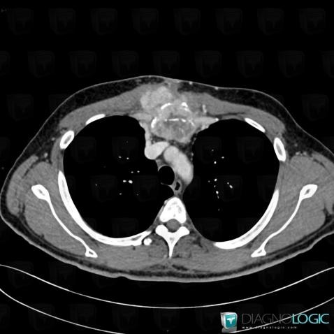 Metastasis, Mediastinum, CT