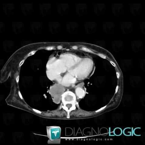 Metastasis, Mediastinum, CT