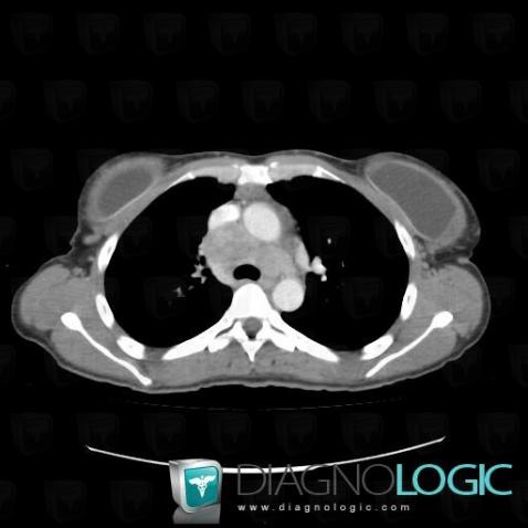 Metastasis, Mediastinum, CT