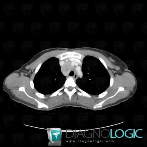 Metastasis, Mediastinum, CT