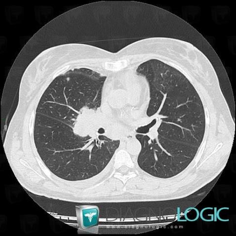 Metastasis, Mediastinum, CT