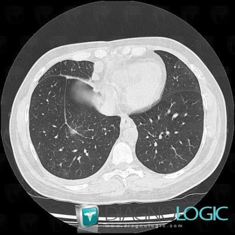 Metastasis, Mediastinum, CT