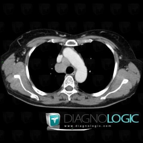 Metastasis, Mediastinum, CT