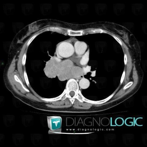 Metastasis, Mediastinum, CT