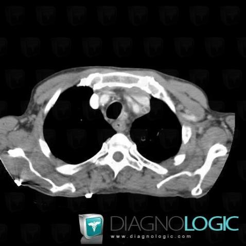 Metastasis, Mediastinum, CT