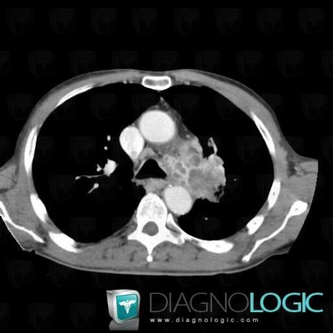 Metastasis, Mediastinum, CT