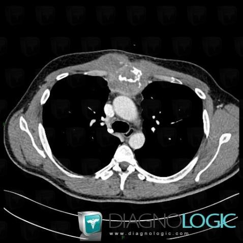 Metastasis, Mediastinum, CT