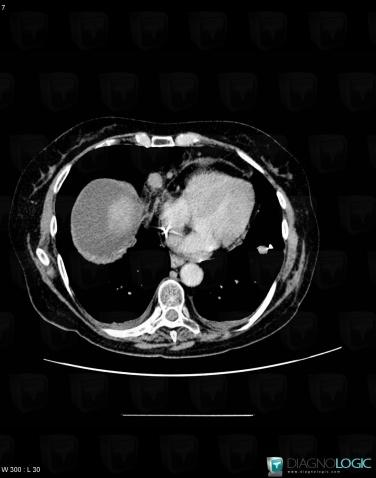 Metastasis, Mediastinum, CT