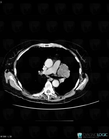 Metastasis, Mediastinum, CT