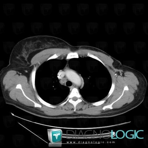 Metastasis, Mediastinum, CT