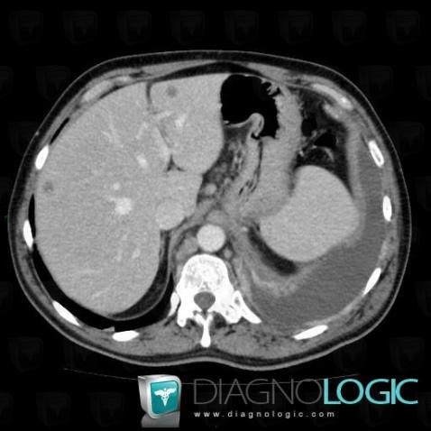 Metastasis, Mediastinum, Liver, CT