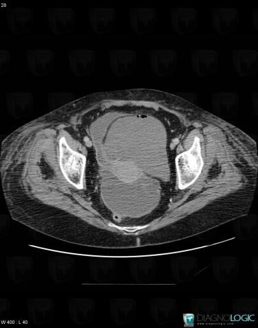 Metastasis, Mesentery / Peritoneum, CT