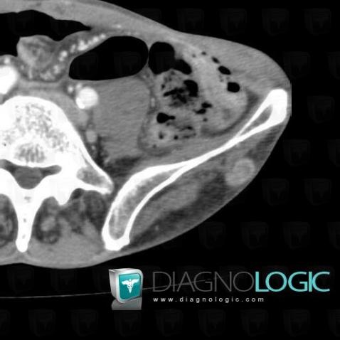 Metastasis, Other soft tissues/nerves - Pelvis, CT