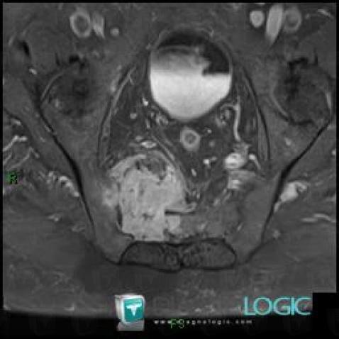 Metastasis, Other soft tissues/nerves - Pelvis, MRI