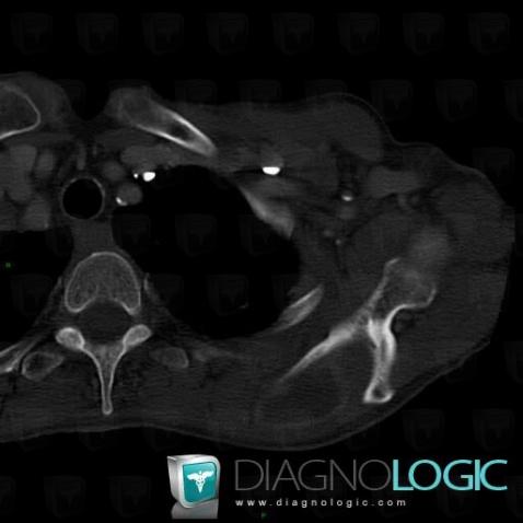 Metastasis, Other soft tissues/nerves - Shoulder, CT