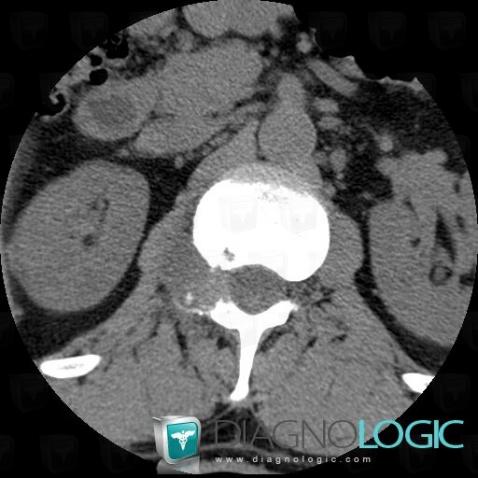 Metastasis, Paraspinal, CT