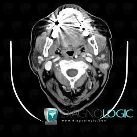 Metastasis, Parotid and other salivary glands, CT