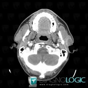 Metastasis, Parotid and other salivary glands, CT