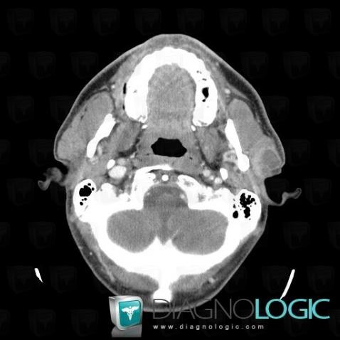 Metastasis, Parotid and other salivary glands, CT