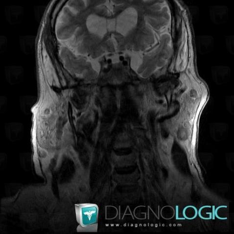 Metastasis, Parotid and other salivary glands, MRI