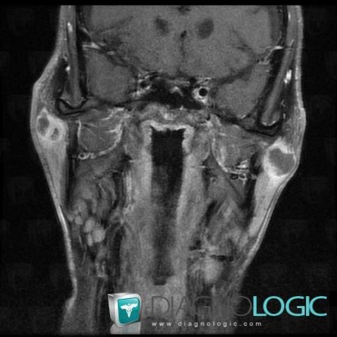 Metastasis, Parotid and other salivary glands, MRI
