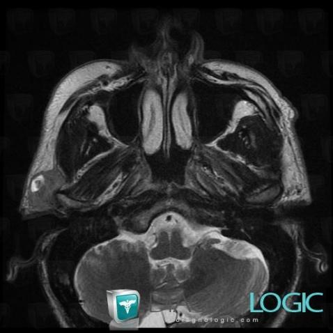 Metastasis, Parotid and other salivary glands, MRI