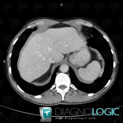 Metastasis, Pleura, CT