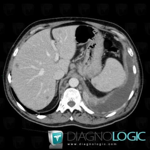 Metastasis, Pleura, Spleen, CT