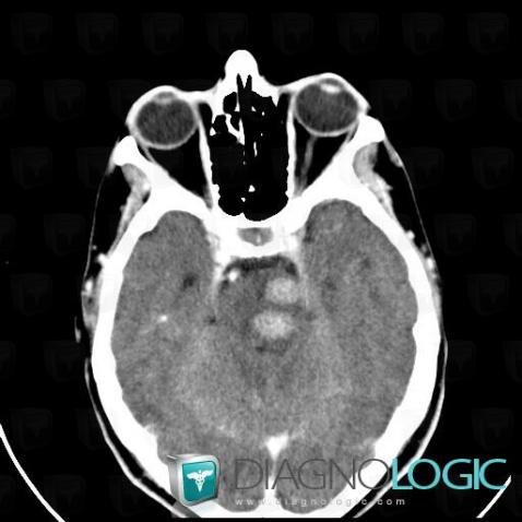 Metastasis, Posterior fossa, CT