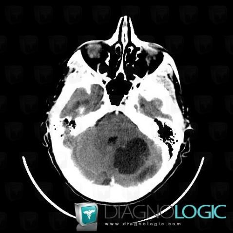 Metastasis, Posterior fossa, CT