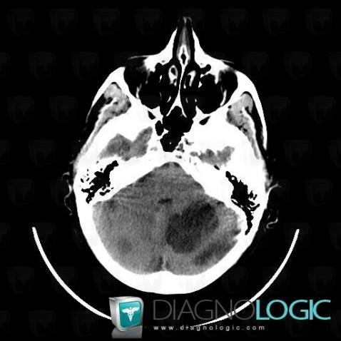 Metastasis, Posterior fossa, CT