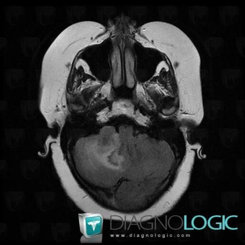 Metastasis, Posterior fossa, MRI