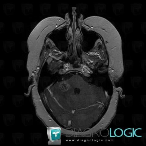 Metastasis, Posterior fossa, MRI