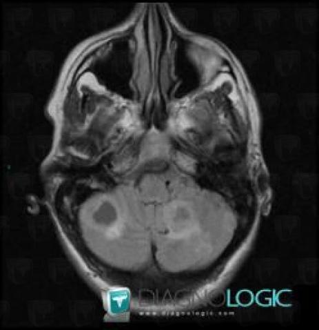 Metastasis, Posterior fossa, MRI